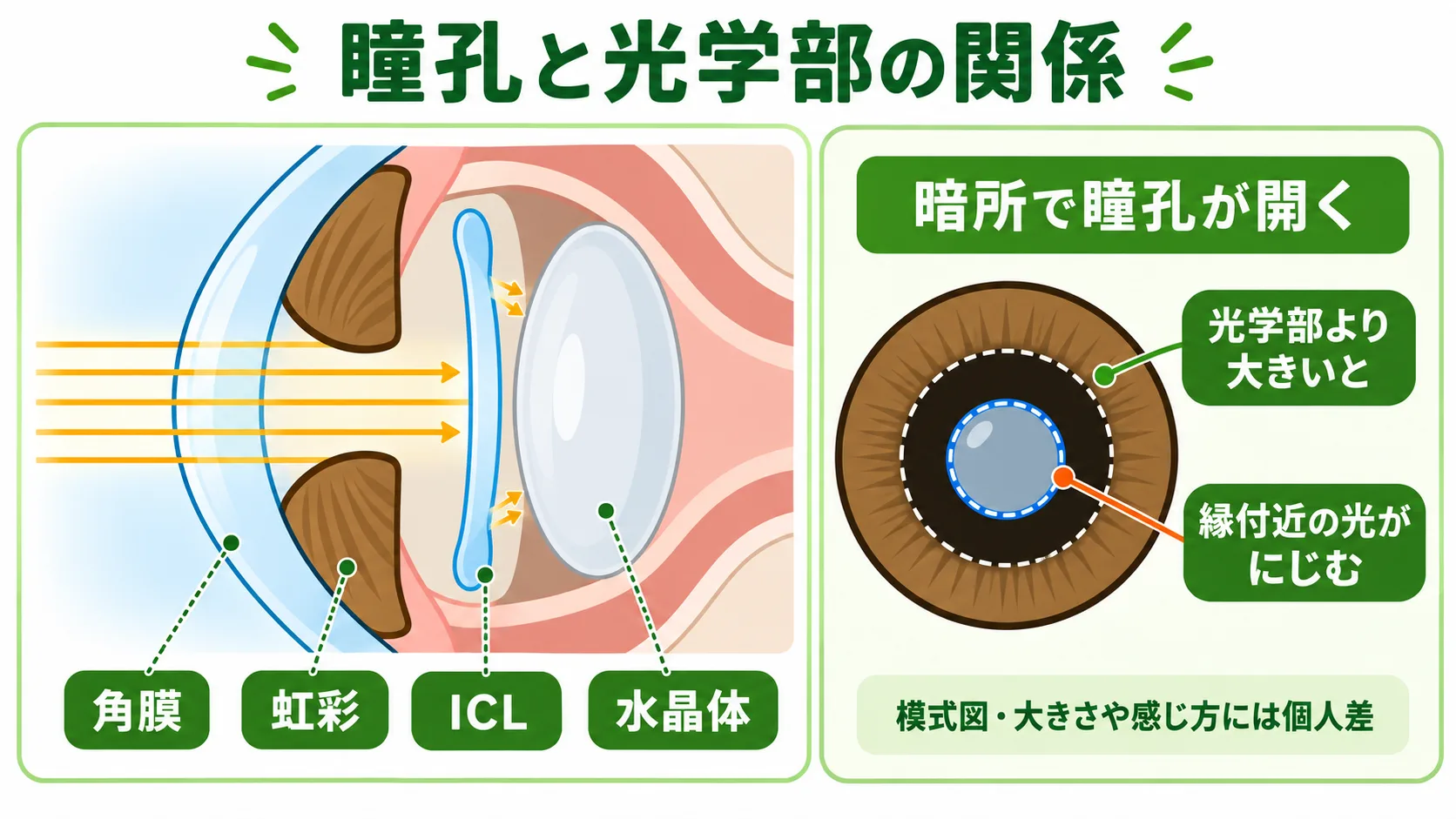 瞳孔と光学部の関係：ICLは虹彩の後ろ・水晶体の前に入る。暗所で瞳孔がレンズの光学部より大きく開くと、縁付近の光がにじむ