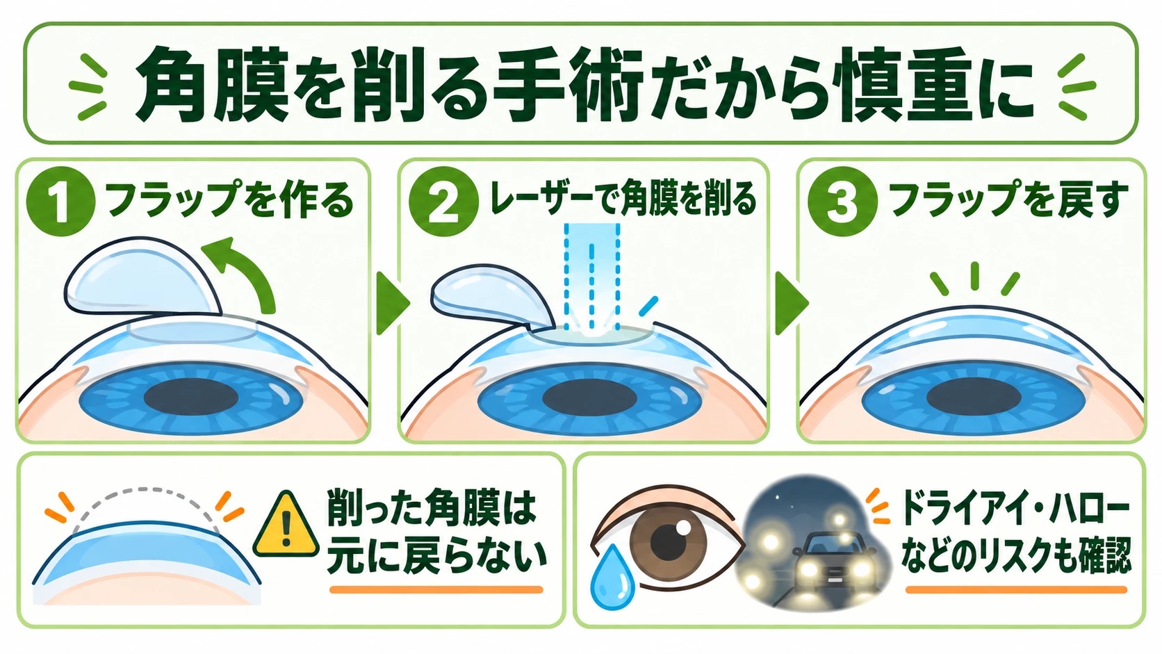 角膜を削る手術だから慎重に：フラップを作る、レーザーで角膜を削る、フラップを戻す。削った角膜は元に戻らず、ドライアイ・ハローなどのリスクも確認